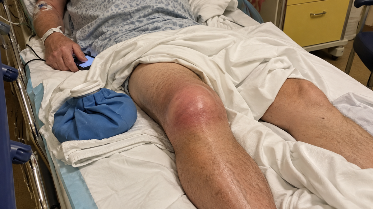 Severe gout flare in a swollen knee requiring emergency care